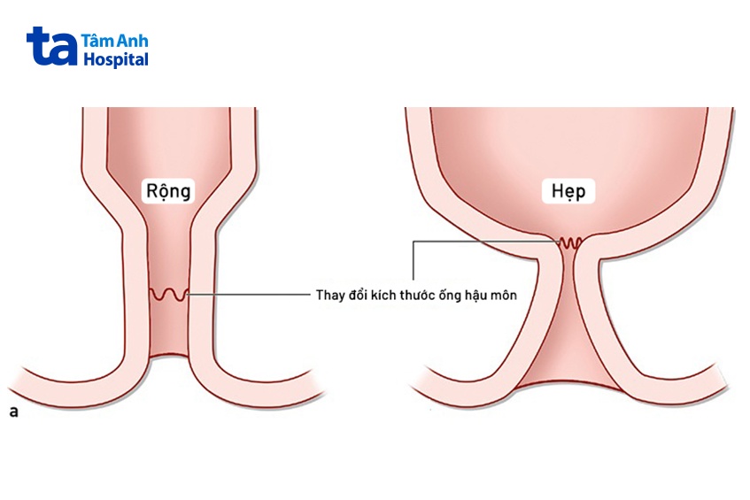 phẫu thuật trĩ bằng phương pháp hcpt