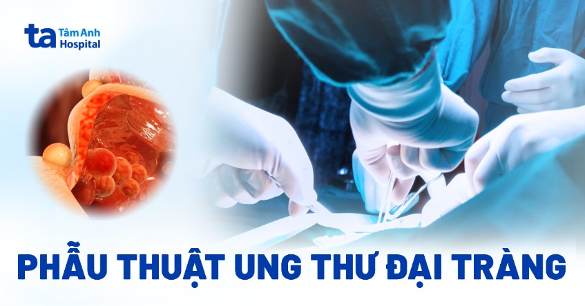 Phẫu thuật ung thư đại tràng: Hiệu quả, quy trình, ưu và nhược điểm