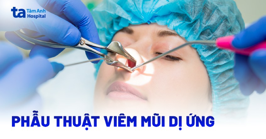 Phẫu thuật viêm mũi dị ứng: Khi nào cần mổ, quy trình thực hiện