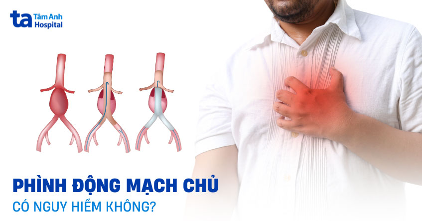 Bệnh phình động mạch chủ có nguy hiểm không? 8 biến chứng