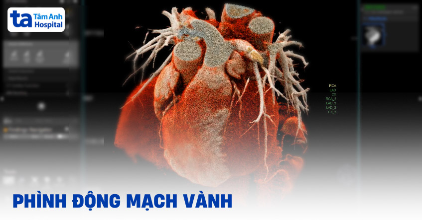 phình động mạch vành