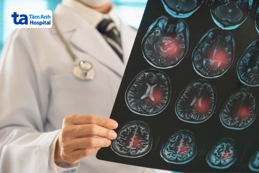 phục hồi sau tai biến phụ thuộc nhiều yếu tố