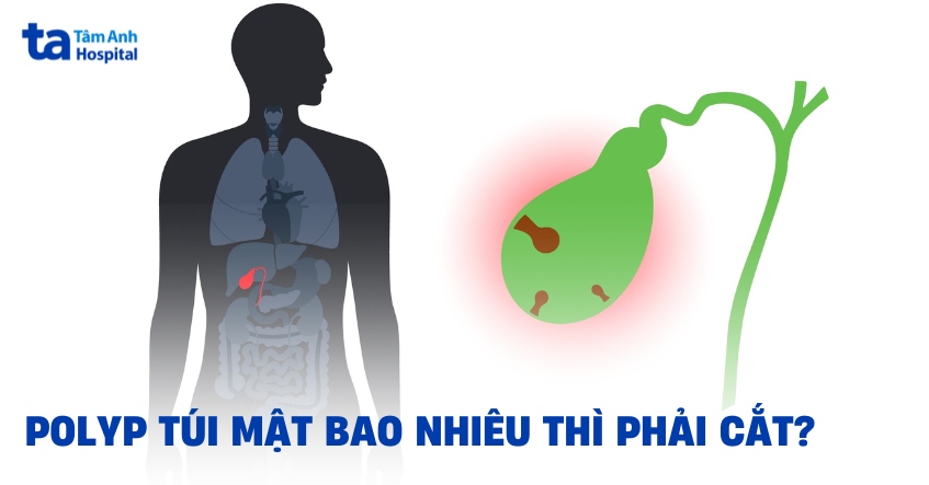 Polyp túi mật bao nhiêu thì phải cắt? Khi nào cần cắt?