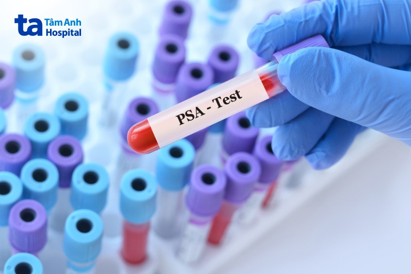 psa test trong tầm soát ung thư tuyến tiền liệt