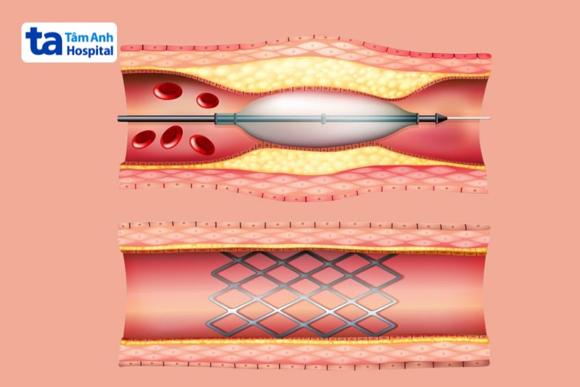 quy trình nong bóng đặt stent