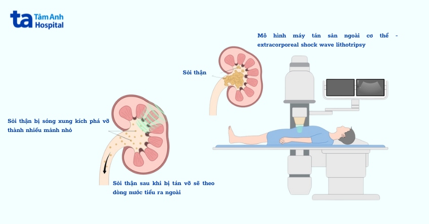 quy trình tán sỏi ngoài cơ thể