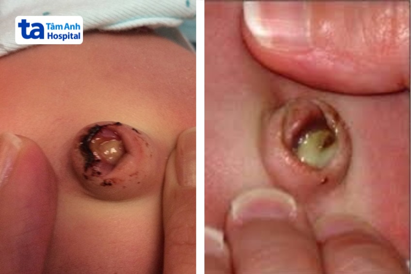 rốn nhiễm khuẩn, chảy dịch mủ