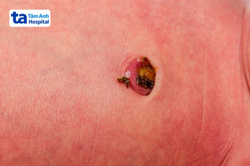 rốn nhiễm trùng, tấy đỏ, có dịch mủ