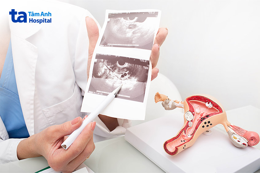 Siêu âm bơm nước buồng tử cung được chỉ định để đánh giá về chức năng sinh sản của phụ nữ