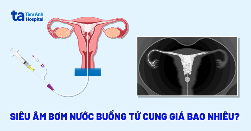Siêu âm bơm nước buồng tử cung giá bao nhiêu tiền? Đắt không?