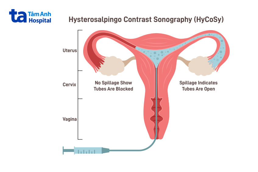 Siêu âm bơm nước buồng tử cung giúp bác sĩ chẩn đoán và loại trừ những bất thường về tử cung và buồng trứng