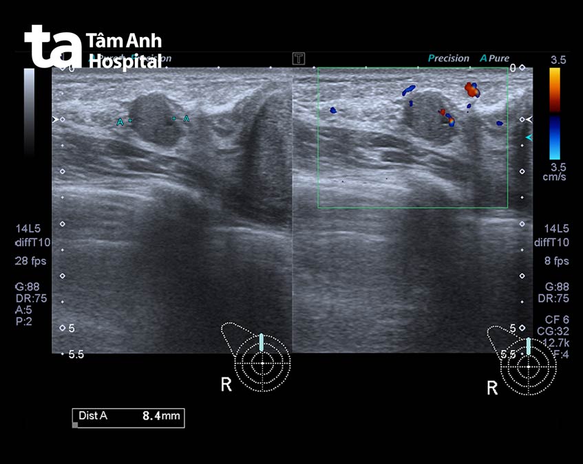siêu âm giúp quan sát bên trong ngực