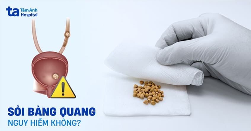 Sỏi bàng quang có nguy hiểm không? Có ảnh hưởng gì không?