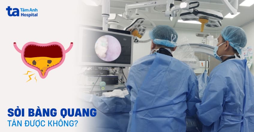 Sỏi bàng quang có tán được không? Khi nào nên thực hiện?