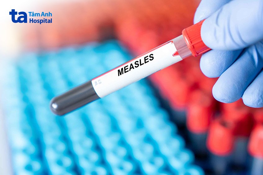 sởi có thể xuất hiện ở người lớn