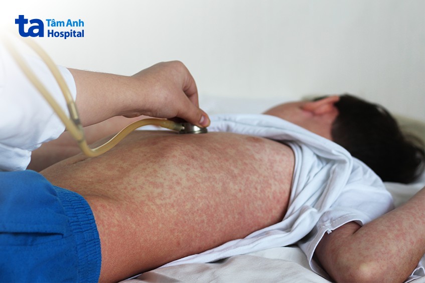 sởi thường tự khỏi