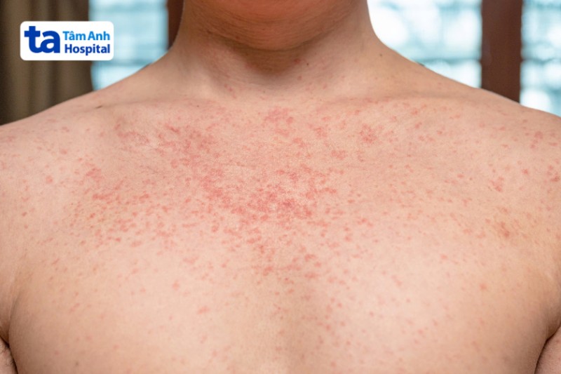 sốt phát ban là bệnh truyền nhiễm