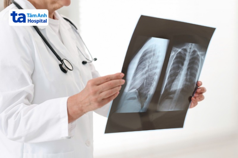chụp x quang khi bị sốt phát ban