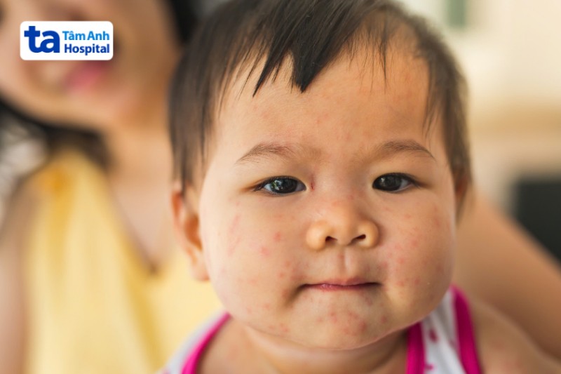 sốt phát ban có khả năng lây lan