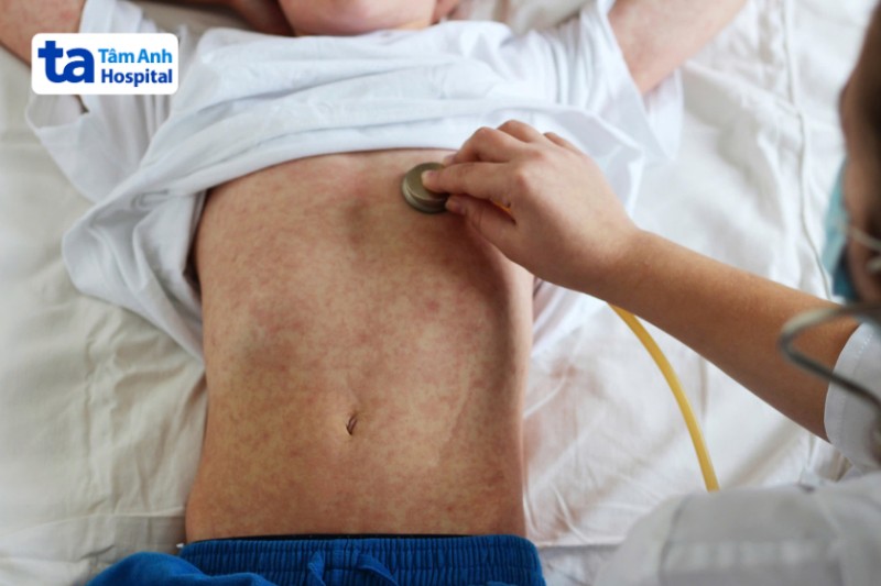 đến bệnh viện ngay nếu phát hiện ban đỏ