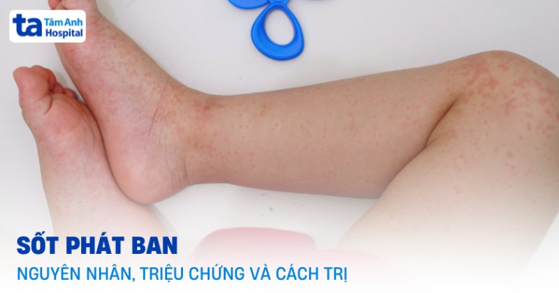 sốt phát ban