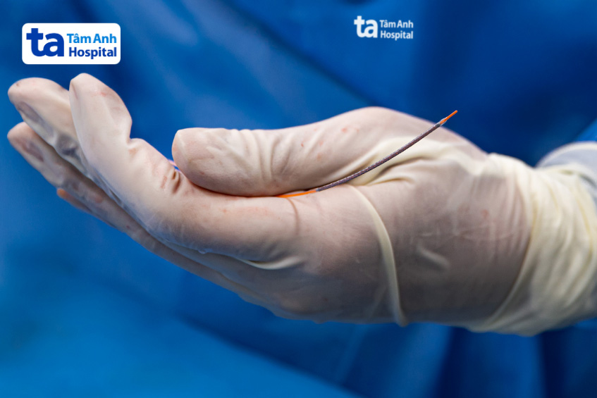 Stent phủ thuốc thế hệ mới nhất XIENCE SIERRA được sử dụng tại Bệnh viện Đa khoa Tâm Anh