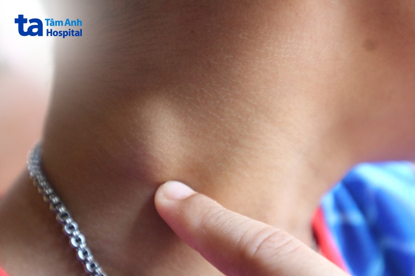 sưng hạch do u lympho không hodgkin tế bào b lớn lan tỏa