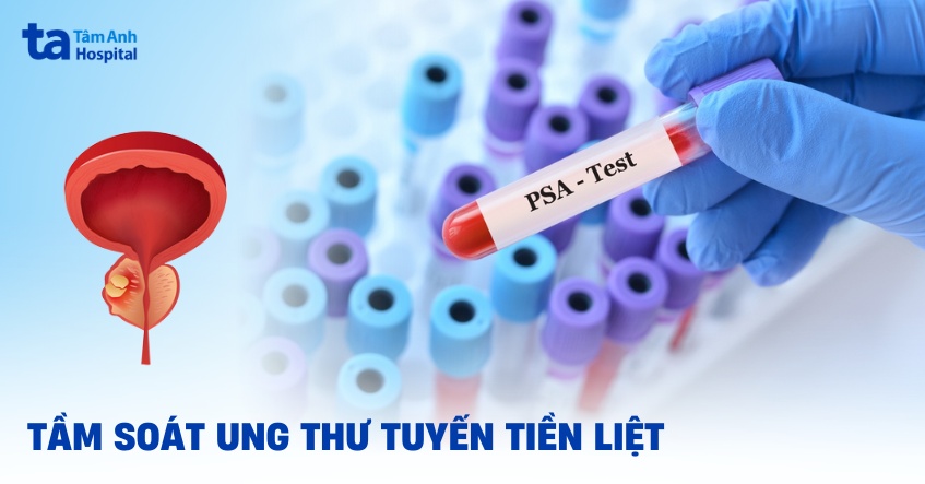 tầm soát ung thư tuyến tiền liệt