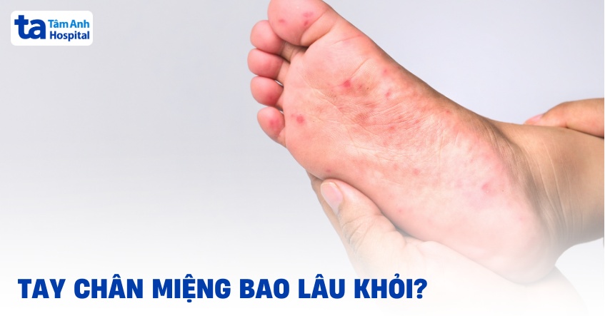 Tay chân miệng bao lâu khỏi? Có lâu không? [Chuyên gia giải đáp]