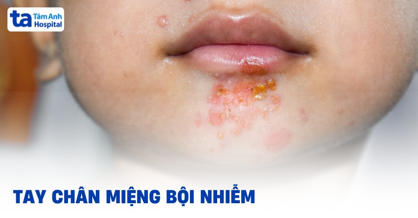 Tay chân miệng bội nhiễm: Nguyên nhân, dấu hiệu, cách phòng ngừa