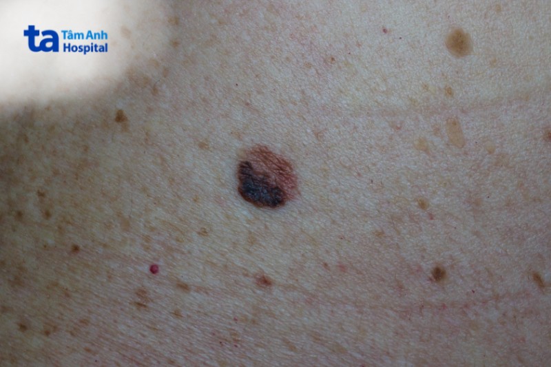 đốm nâu có hình bầu dục
