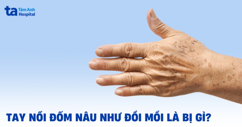Tay nổi đốm nâu như đồi mồi là bị gì? Có cần gặp bác sĩ ngay?