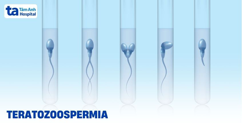 Teratozoospermia (quái tinh): Nguyên nhân, dấu hiệu, cách điều trị