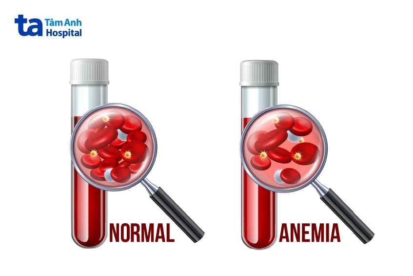 thiếu máu do thiếu sắt ảnh hưởng sức khỏe