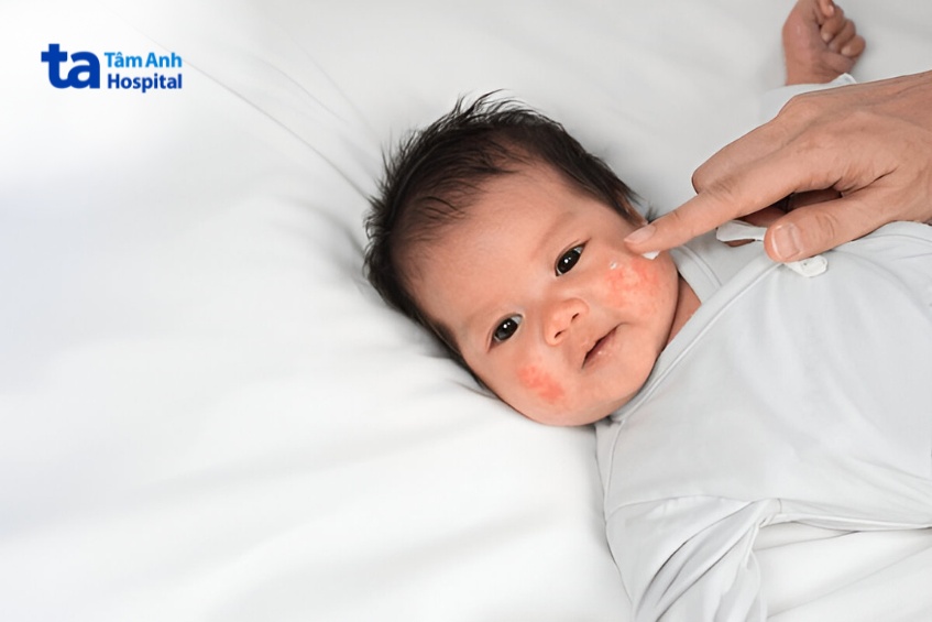 thoa kem dưỡng ẩm cho trẻ để làm dịu da