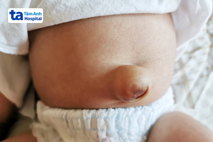 thoát vị rốn ở trẻ sơ sinh