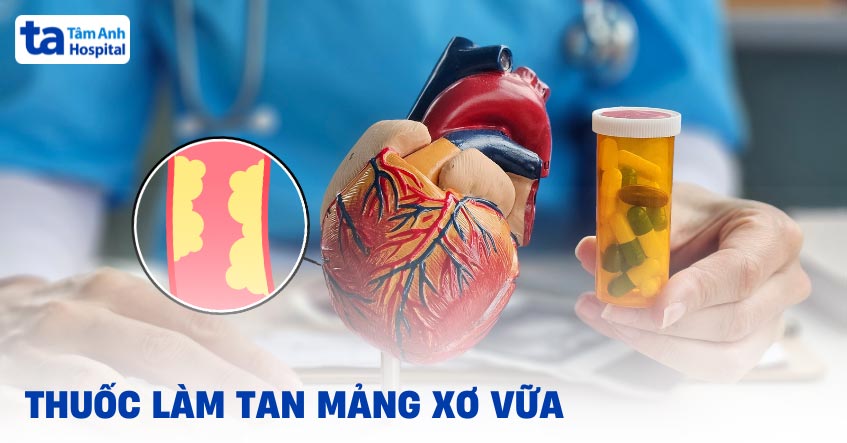 4 nhóm thuốc làm tan mảng xơ vữa phổ biến, điều trị hiệu quả cao