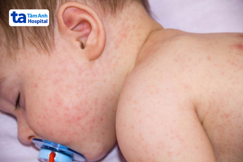 tiêm 6in1 bị nổi mẩn đỏ