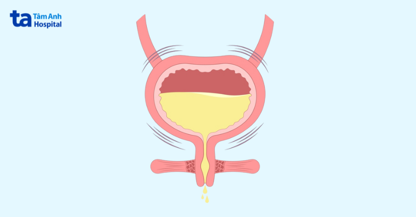 tiểu rắt ở nữ do bàng quang tăng hoạt