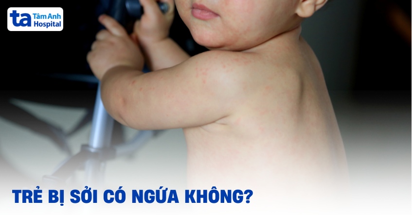 Trẻ bị sởi có ngứa không? 4 cách giảm ngứa hiệu quả và an toàn