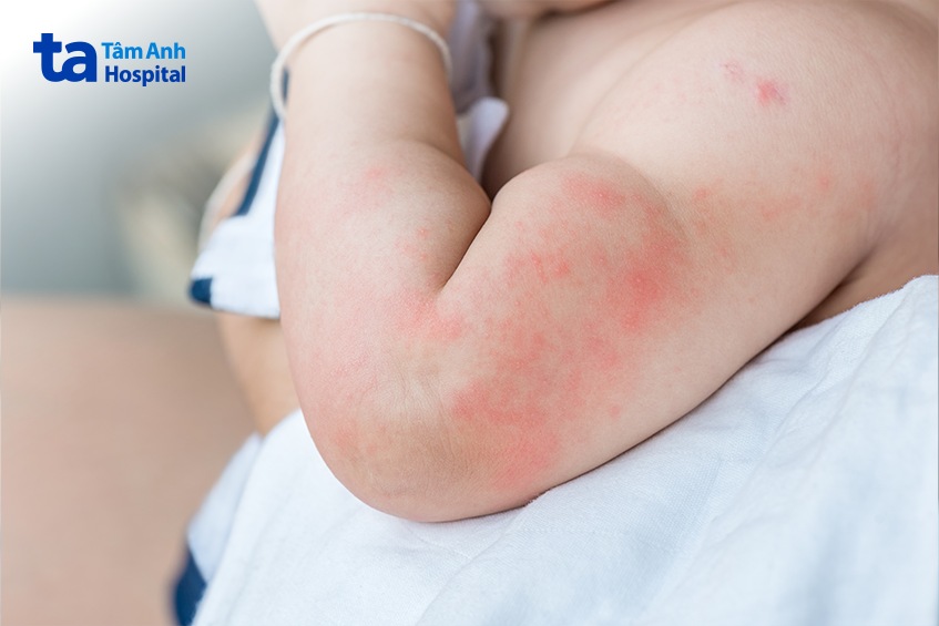 trẻ bị sốt kèm phát ban có thể là dấu hiệu của nhiễm trùng huyết