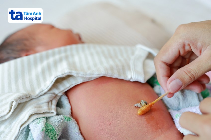 trẻ nhiễm trùng rốn cần được vệ sinh rốn thường xuyên