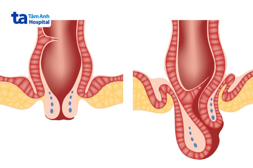 trĩ độ 3 nặng hay nhẹ