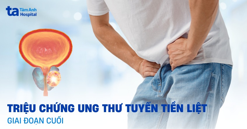Triệu chứng ung thư tuyến tiền liệt giai đoạn cuối và cách điều trị