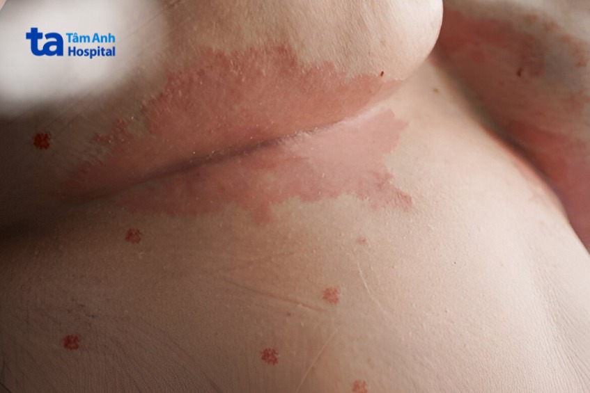 triệu chứng vảy nến thể đảo ngược