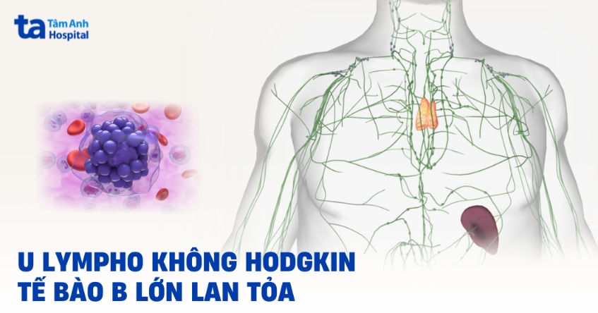 U lympho không Hodgkin tế bào B lớn lan tỏa: Triệu chứng, điều trị