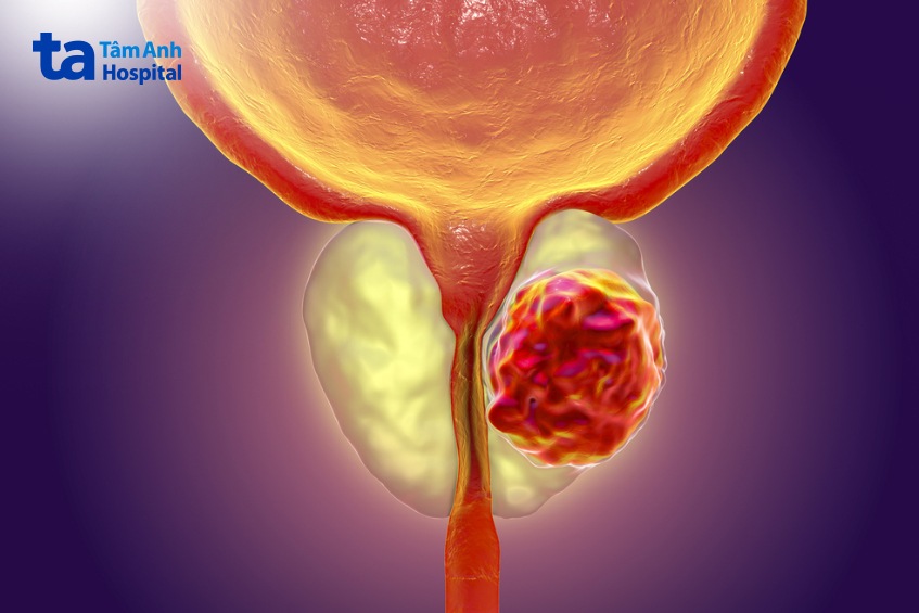 u tuyến tiền liệt chèn ép bàng quang
