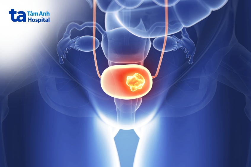 ung thư bàng quang di căn thường không chữa được