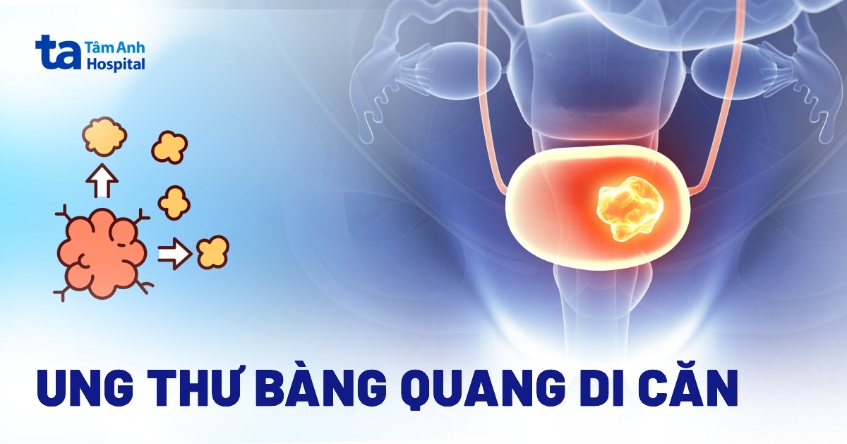 Ung thư bàng quang di căn sống được bao lâu? Triệu chứng, điều trị