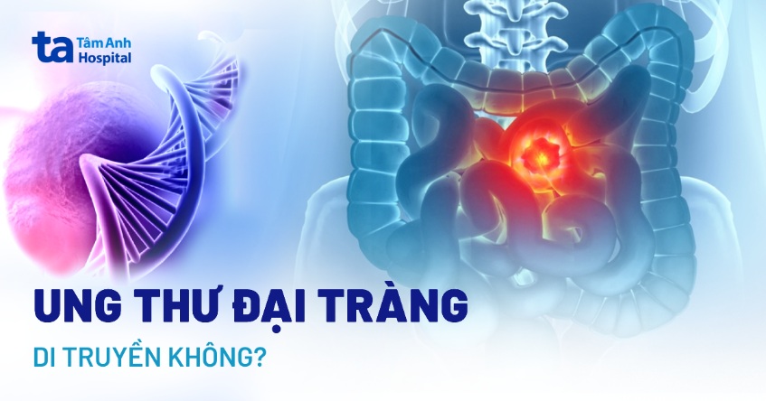 Ung thư đại tràng có di truyền không? Nguyên nhân do đâu?
